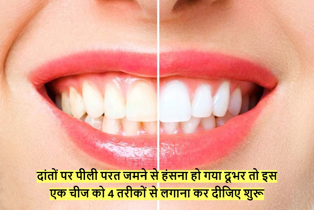 Teeth Whitening Remedies