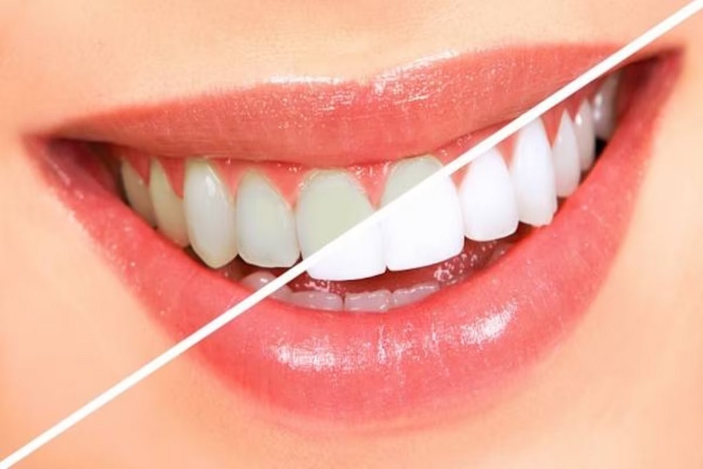 Teeth Whitening Tips