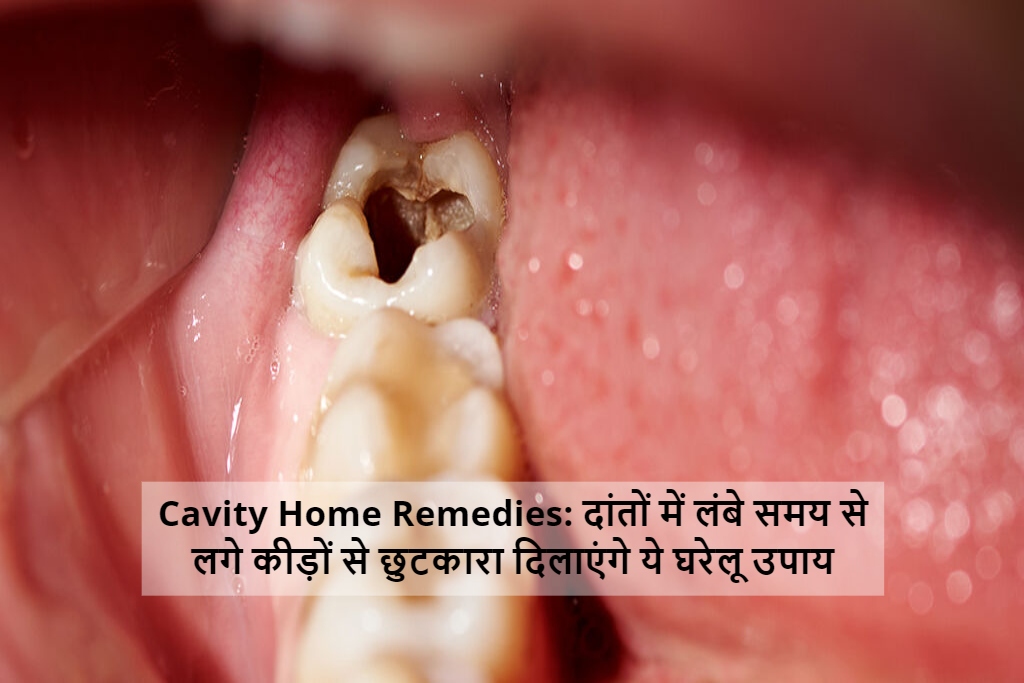 Cavity Home Remedies