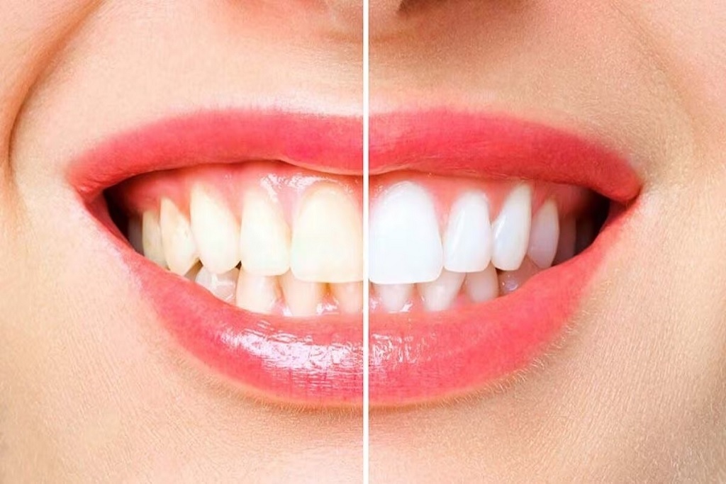 Foods For Teeth Whitening