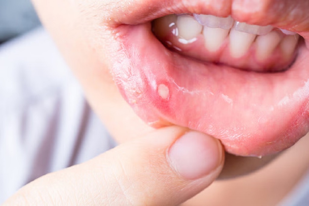 Mouth Ulcer Home Remedy