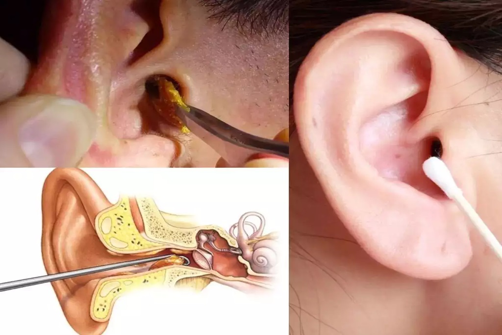 Clean Ear Wax कान के अंदर की गंदगी खुद निकलने लगेगी बाहर आपको करना होगा बस ये काम 2083